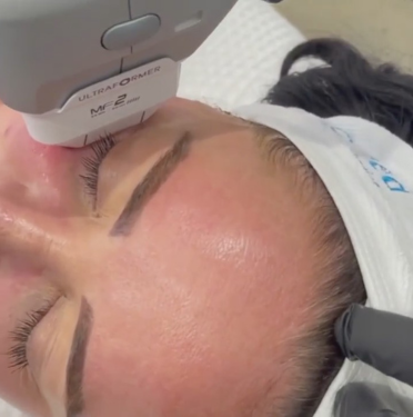 Non-Surgical SMAS Lifting (HIFU)