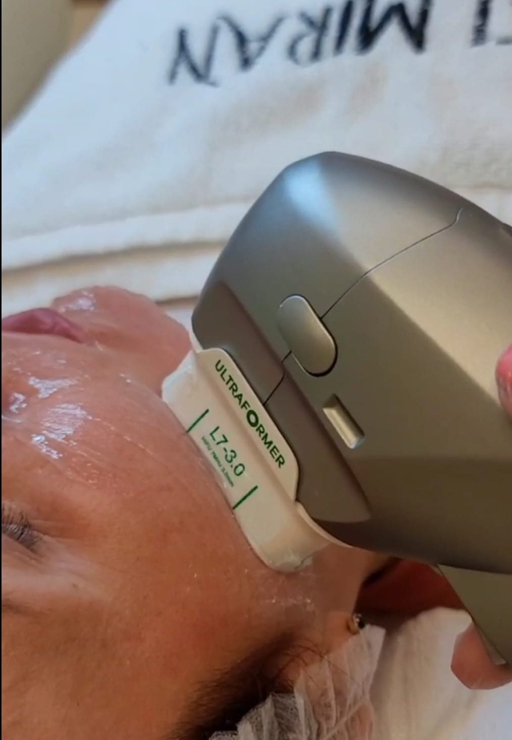 Non-Surgical SMAS Lift