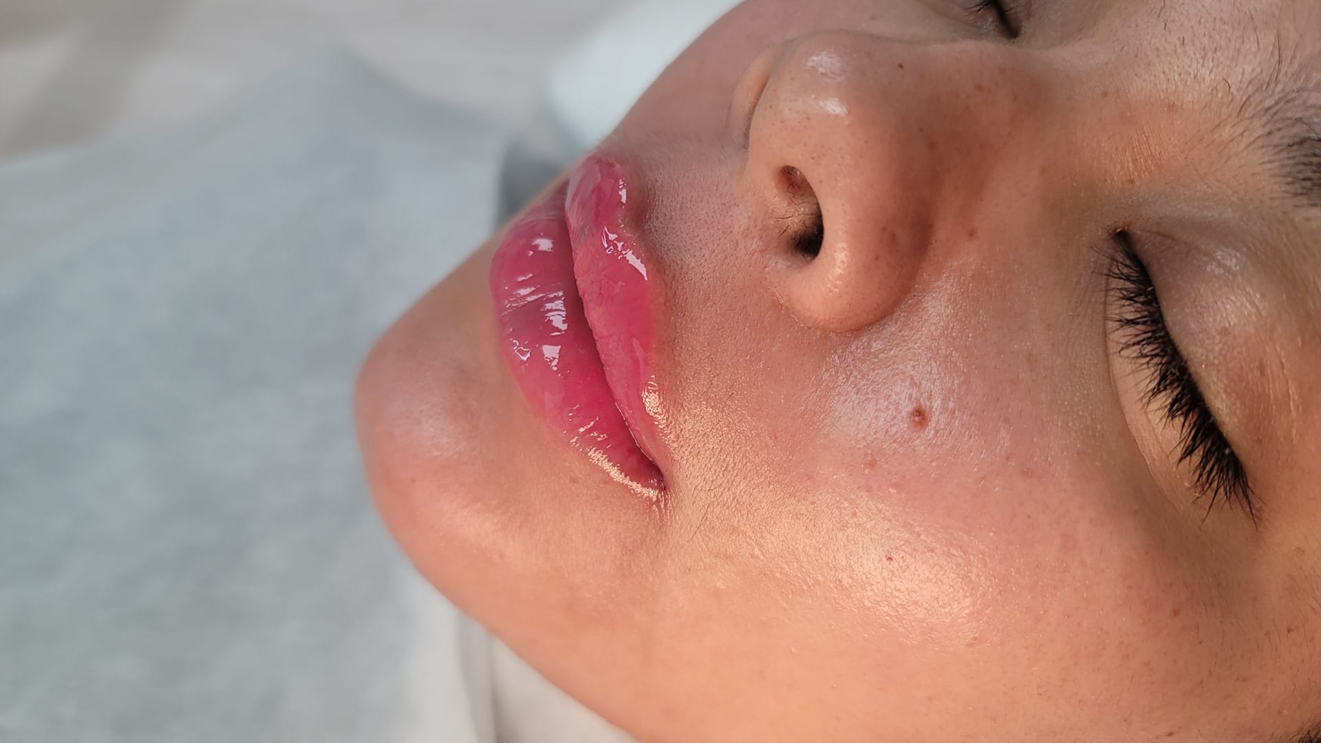 After lip augmentation