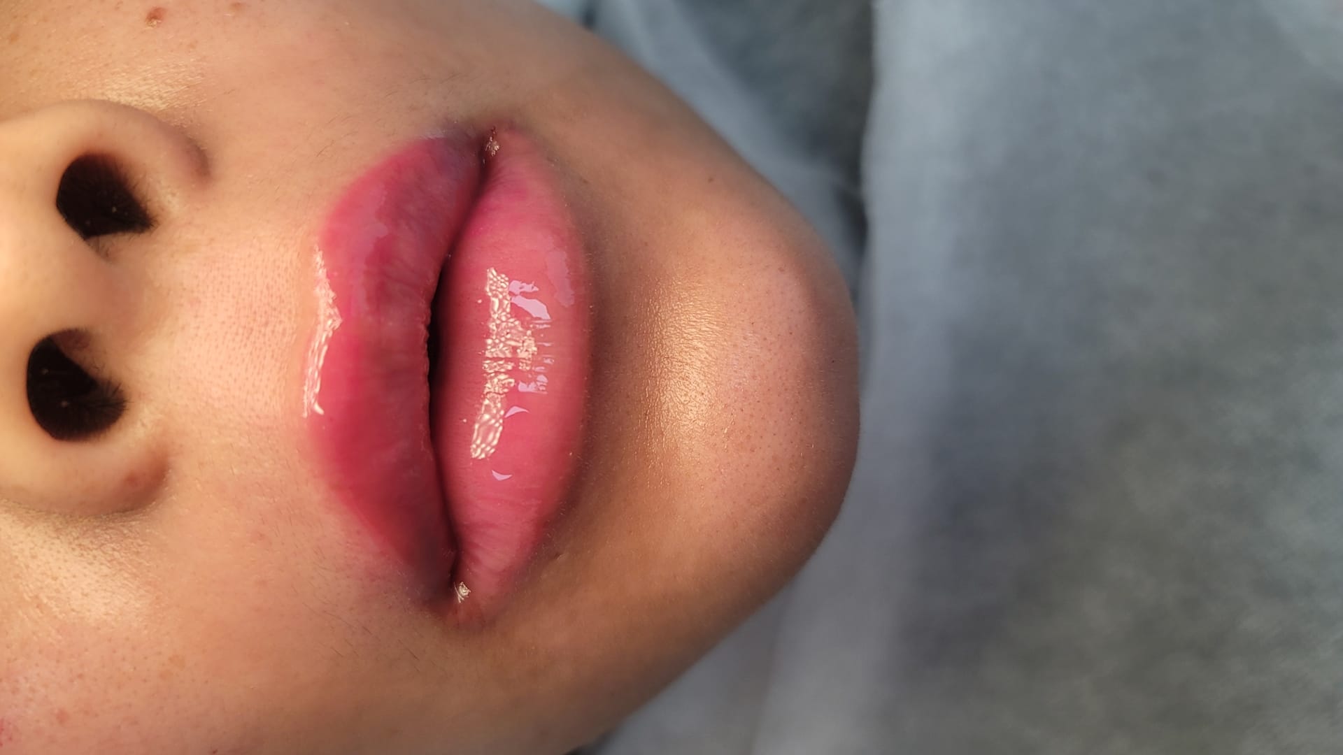 After Lip Enhancement