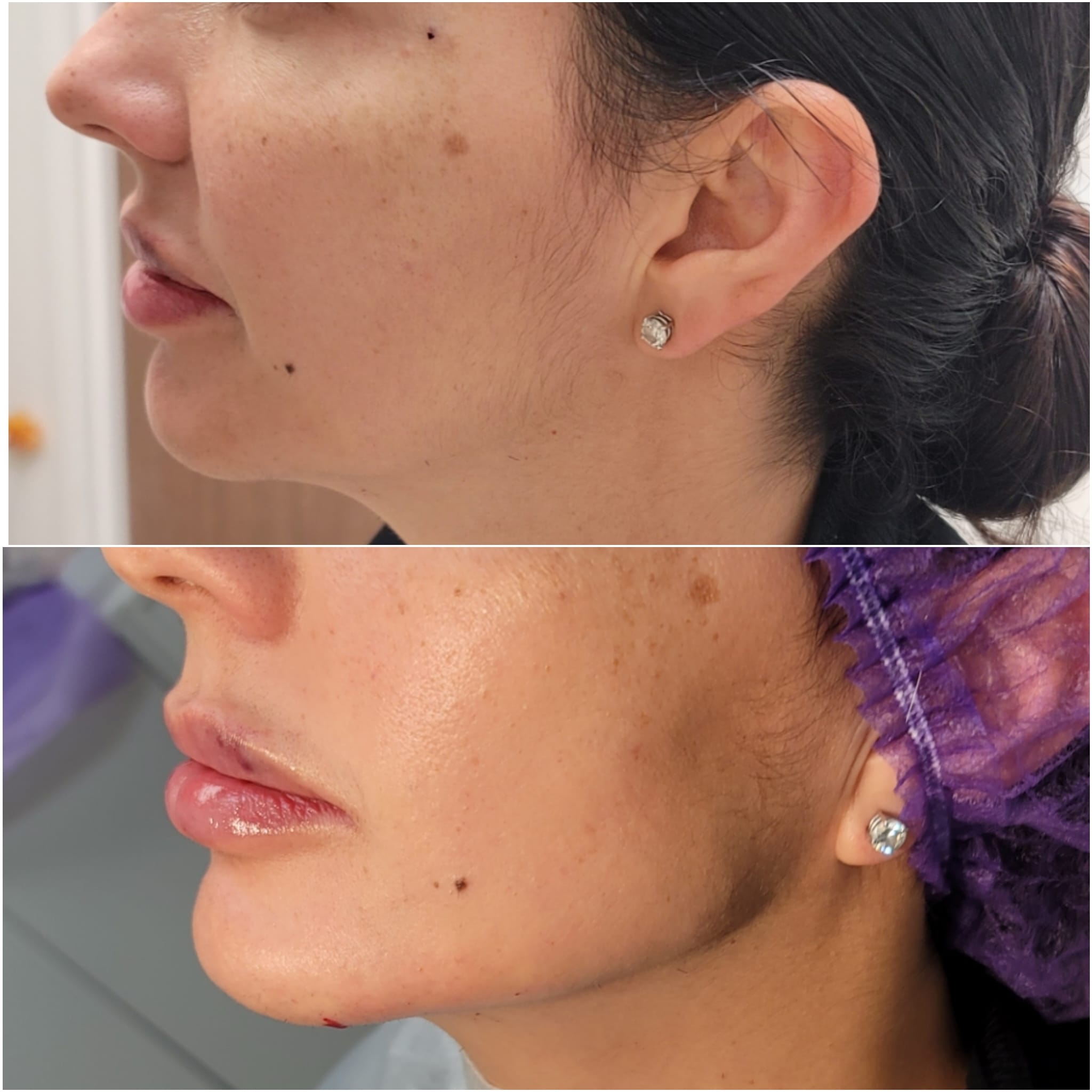 Before and After Nonsurgical Thread Lifting