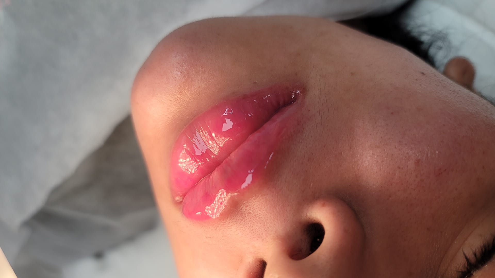 After Lip Augmentation