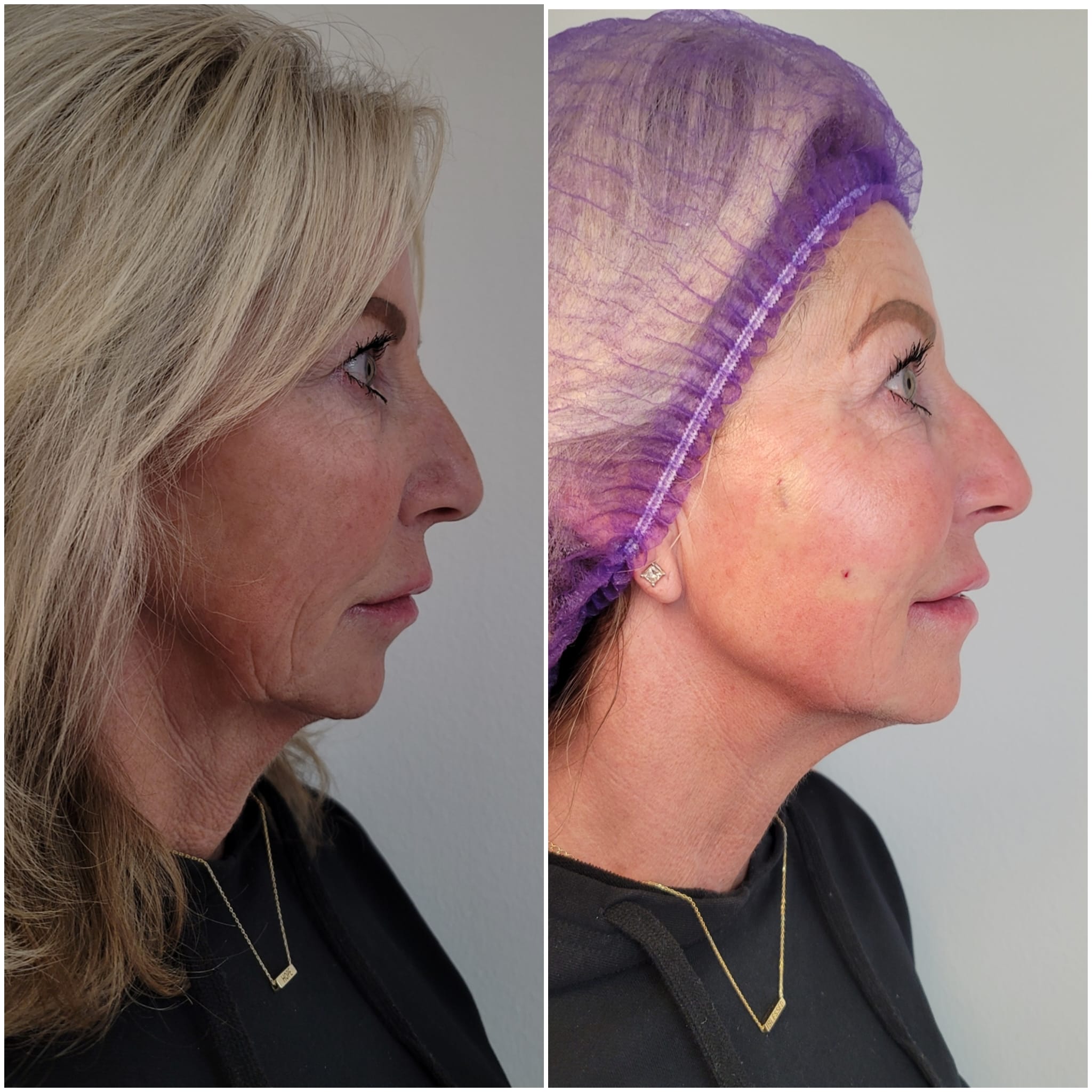 Before and after Skin Tightening