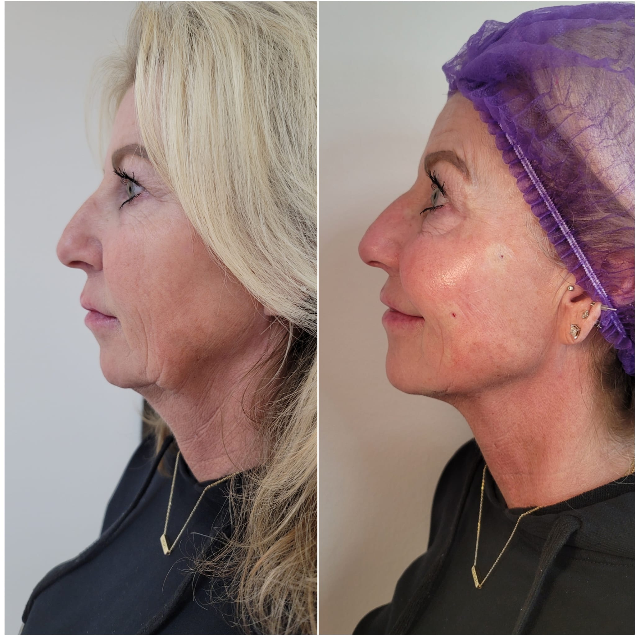 Before and after Non-Surgical Full-Face Transformation
