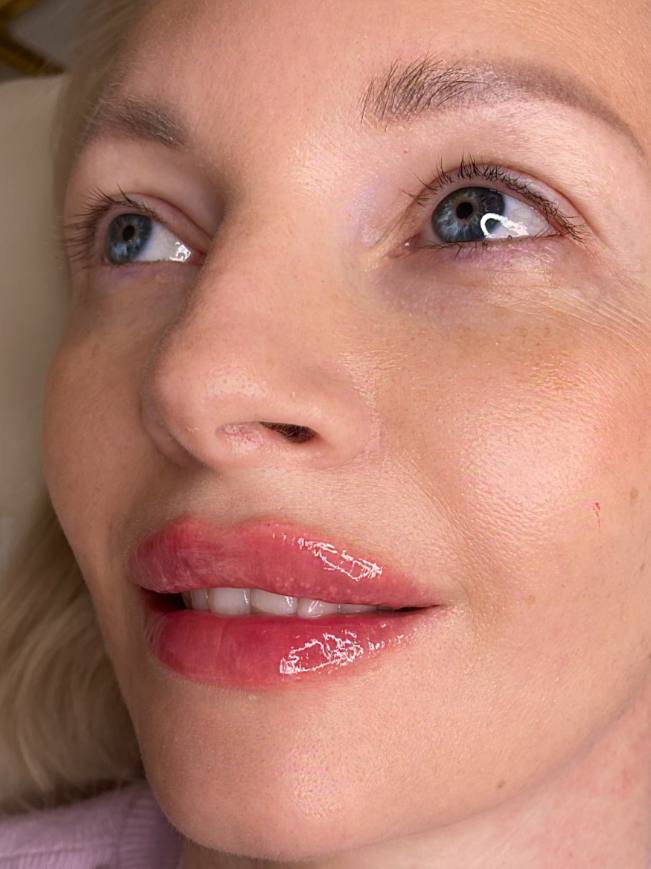 Before and after lip augmentation