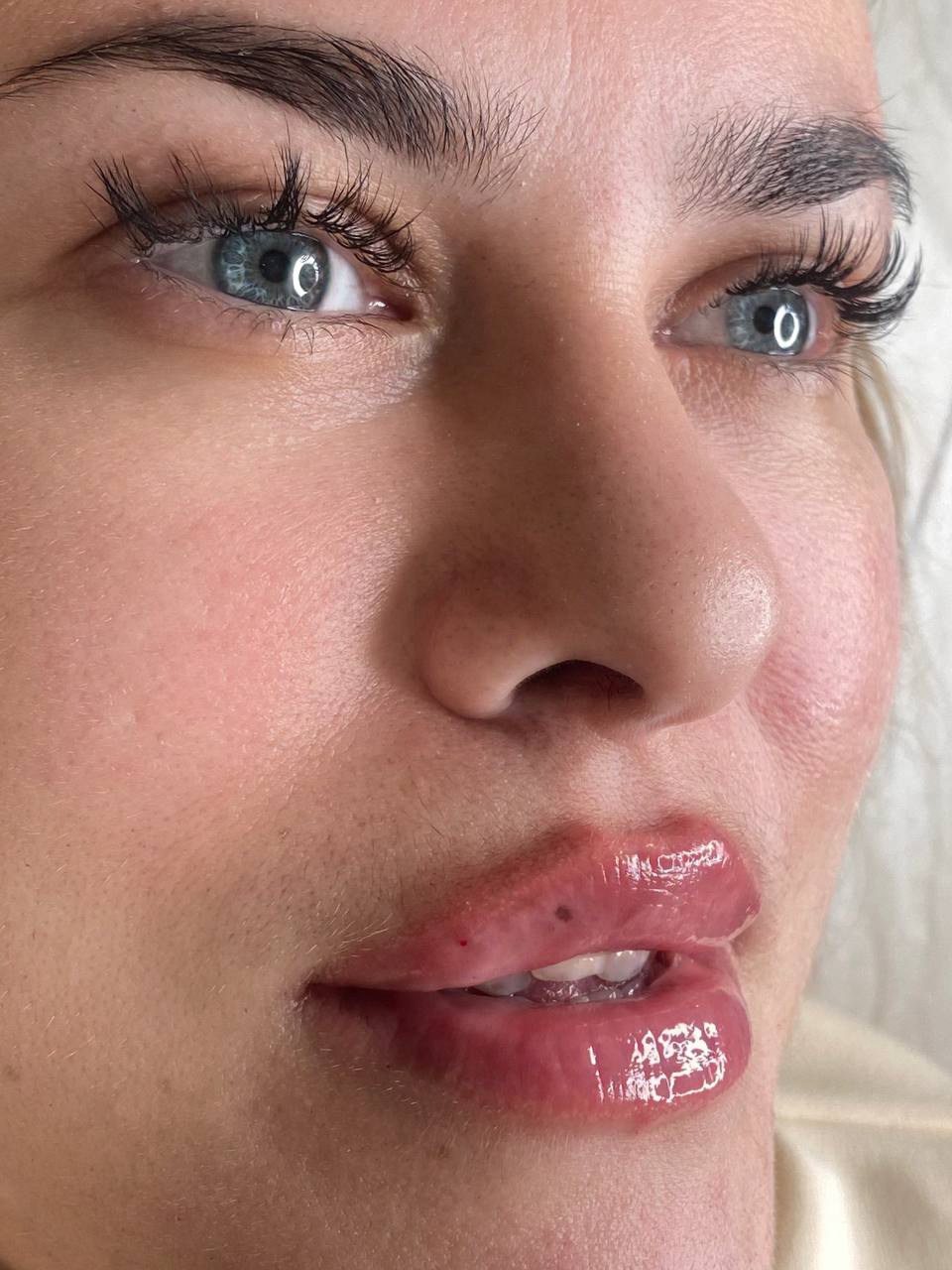 Before and after Nonsurgical Monaco Lip