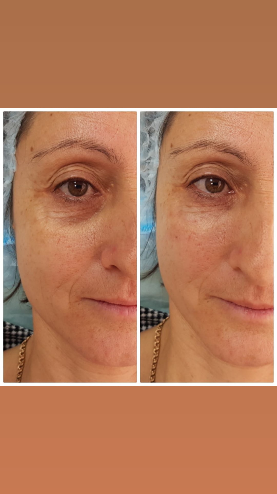 Before and after Under-Eye Filler