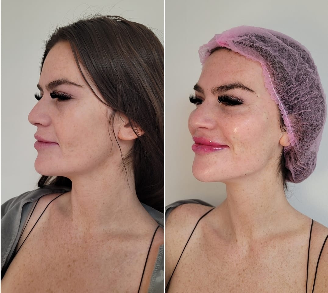 Before and after Non-Surgical Facial Rejuvenation