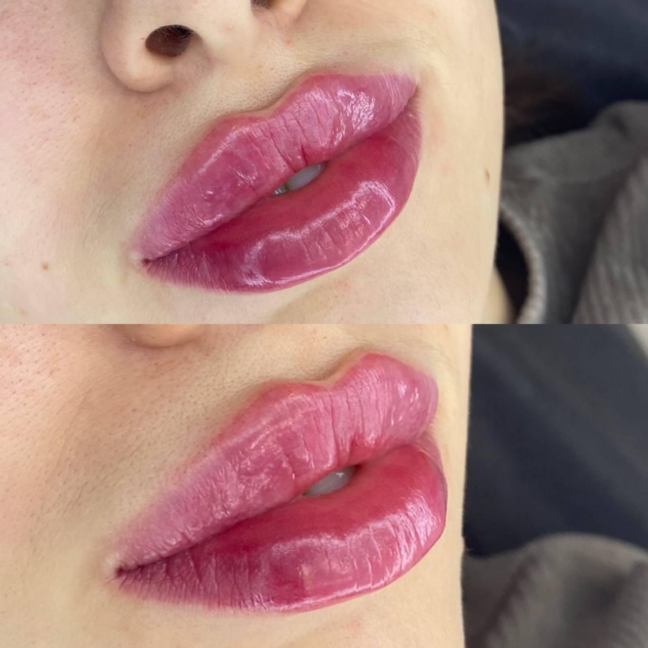 Before and after lip augmentation