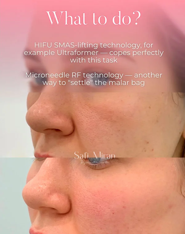 Malar Bags Treatment