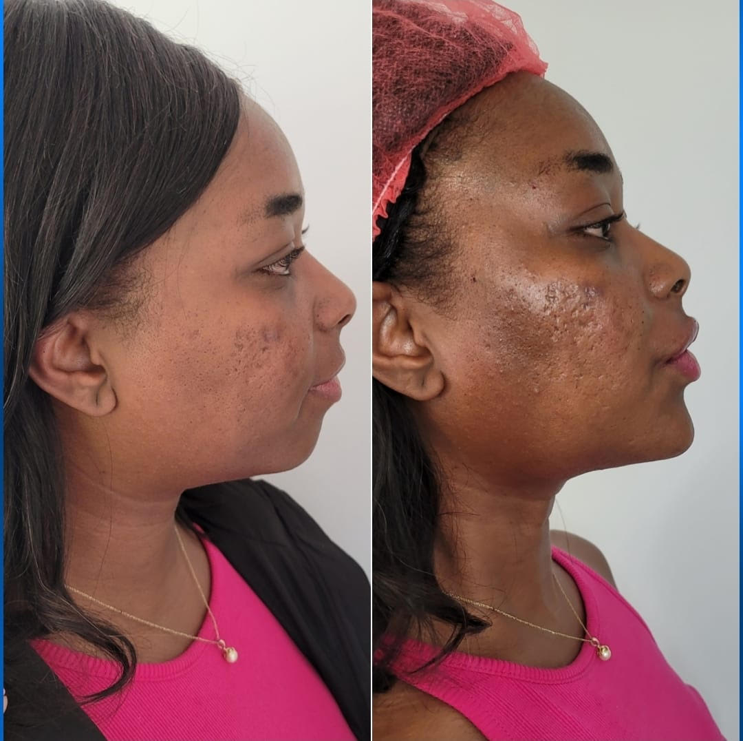 Before and after VI Peel Treatment