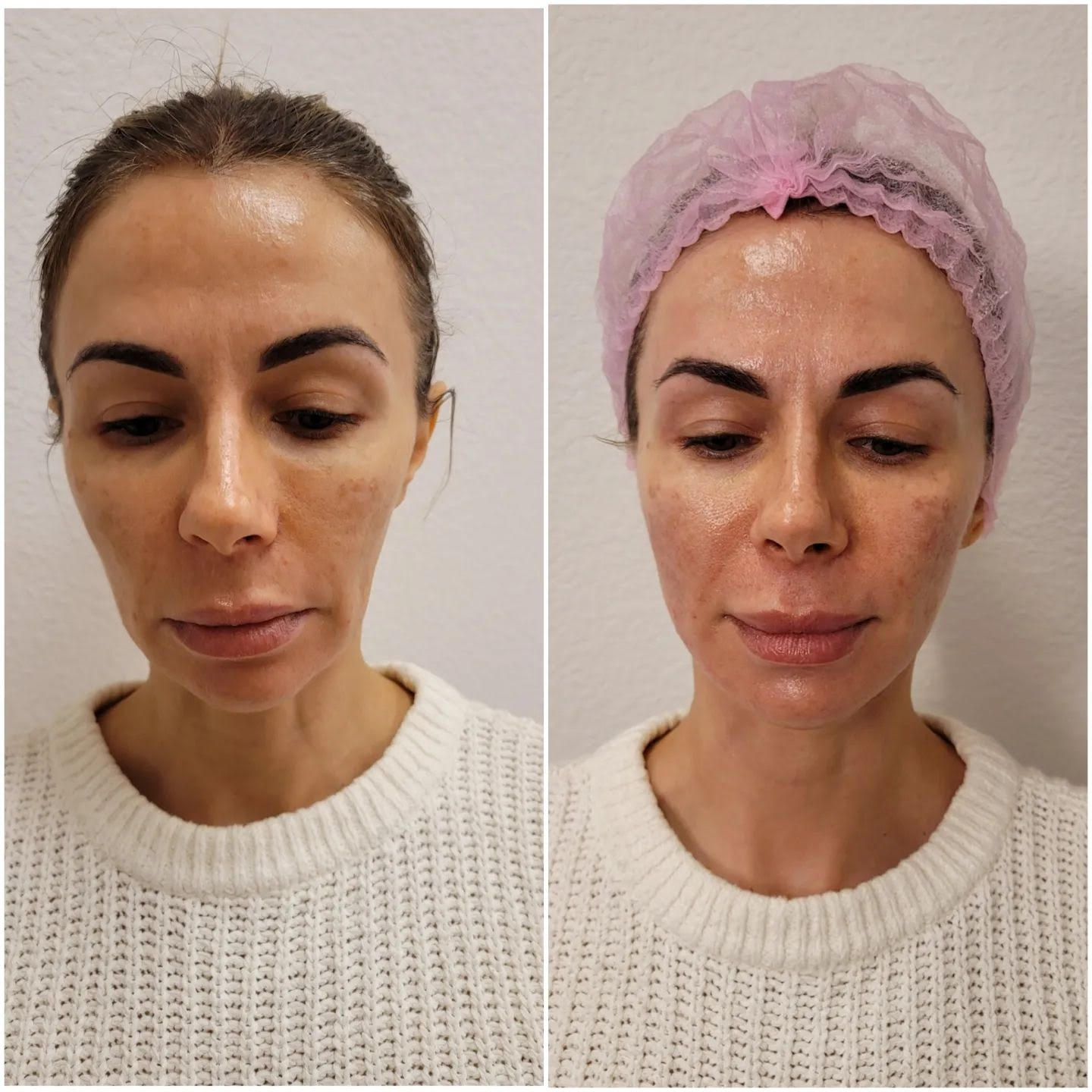 Before and after Face Contouring