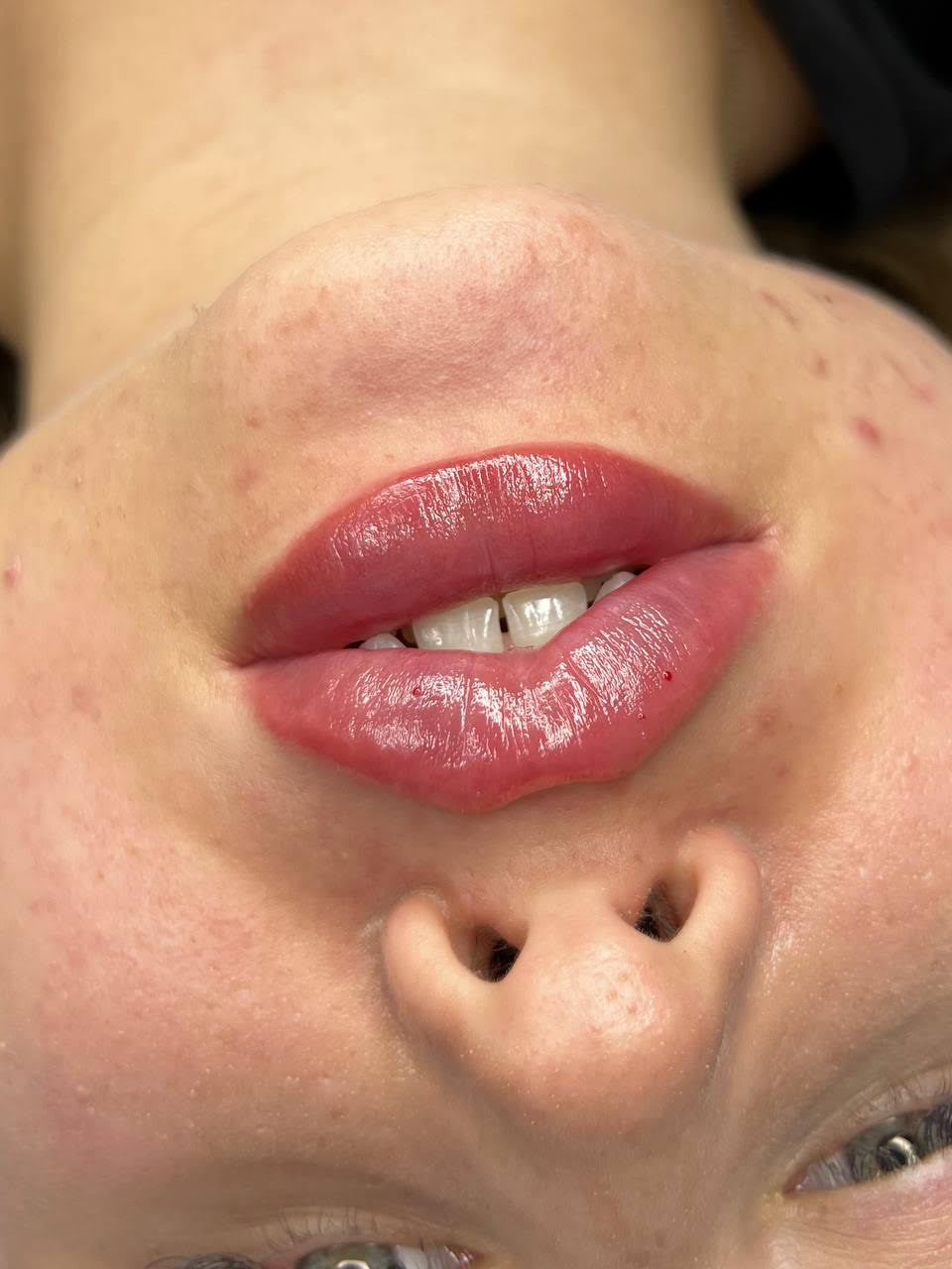 Russian Lip Augmentation