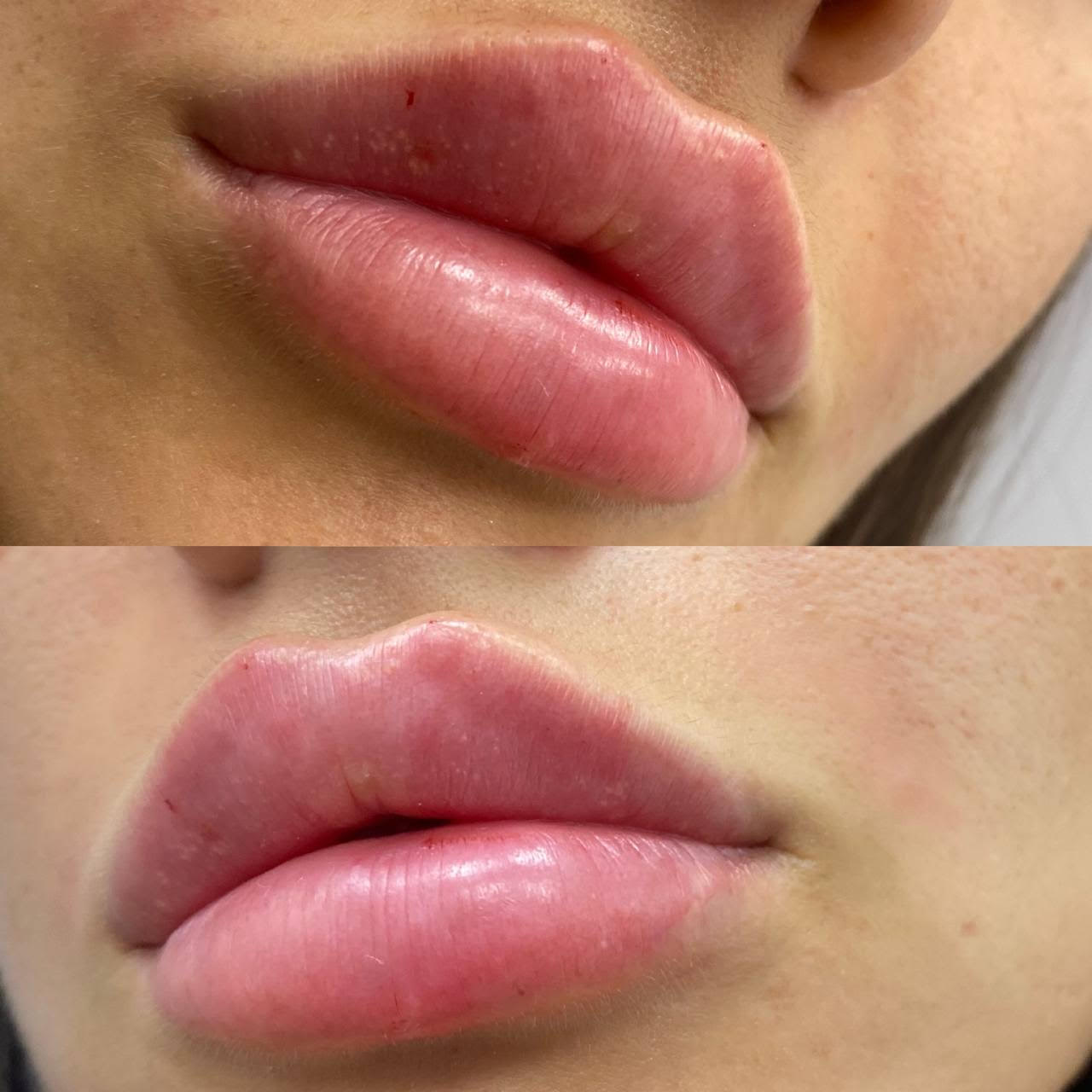 Lip Augmentation Results