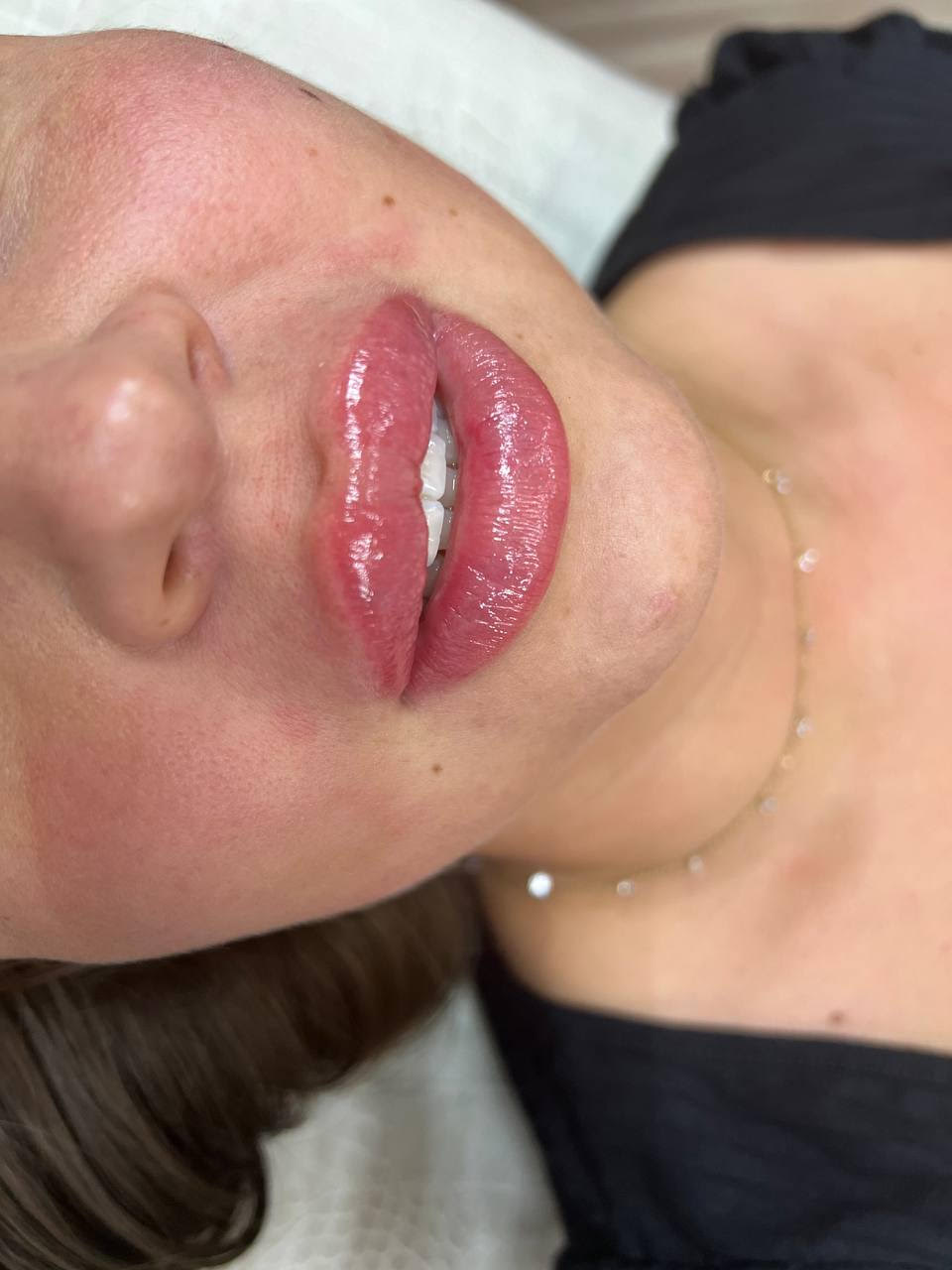 Lip Enhancement