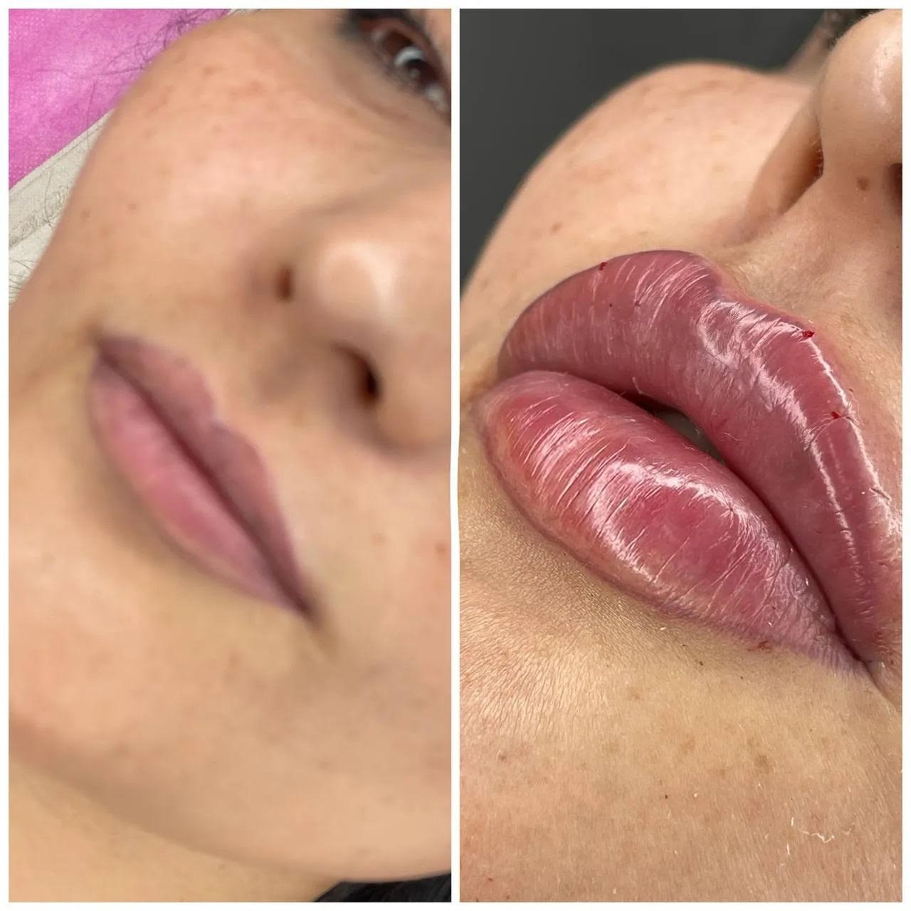 Before and After Lip Filler