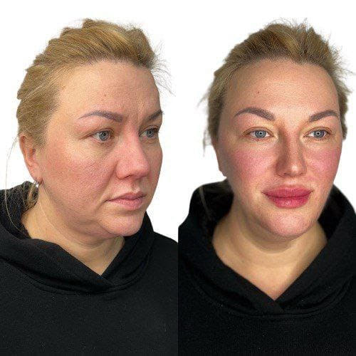Before and after Facial Rejuvenation