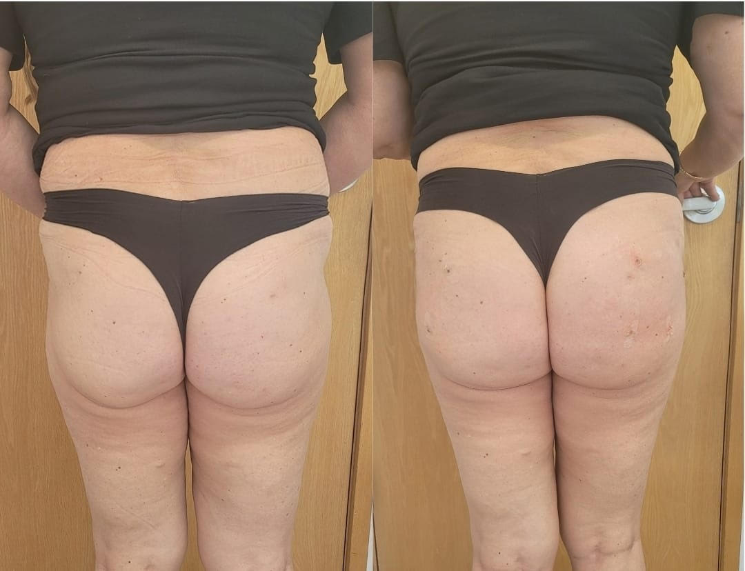 Before and After Non-Surgical Brazilian Butt Augmentation