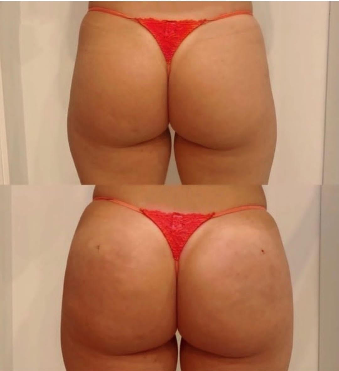 Before and After Non-Surgical Brazilian Butt Lift