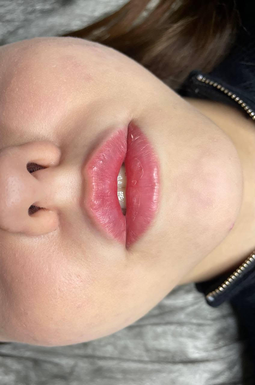 Lip Augmentation