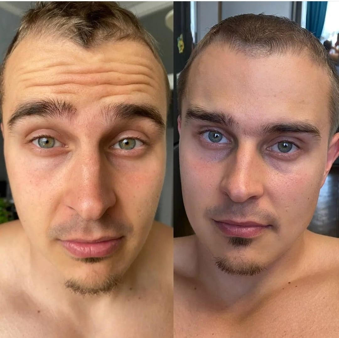 Before and after Skin Tightening