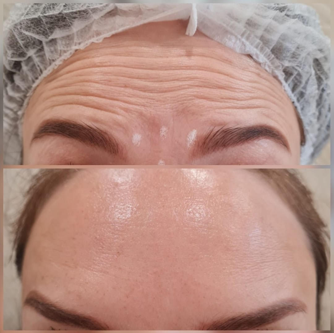 Before and after Botox Treatment