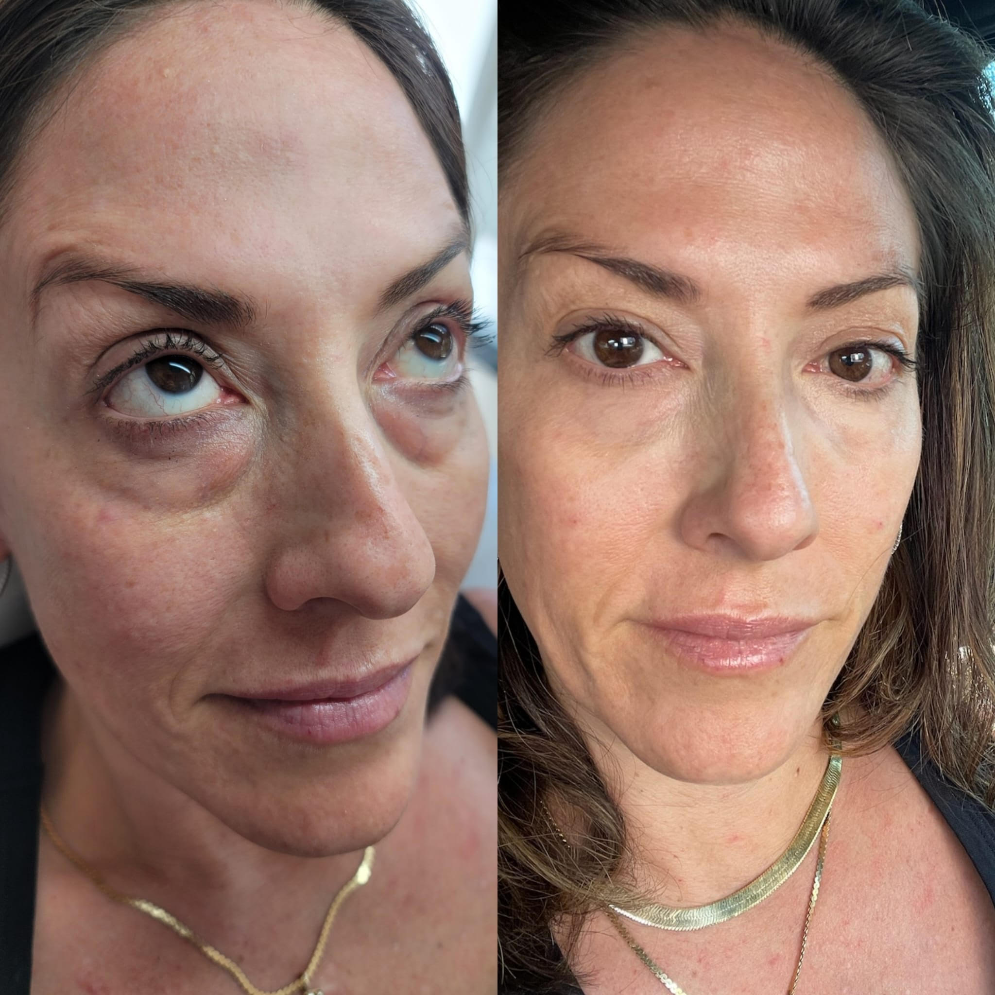 Before and after Under-Eye Filler Treatment