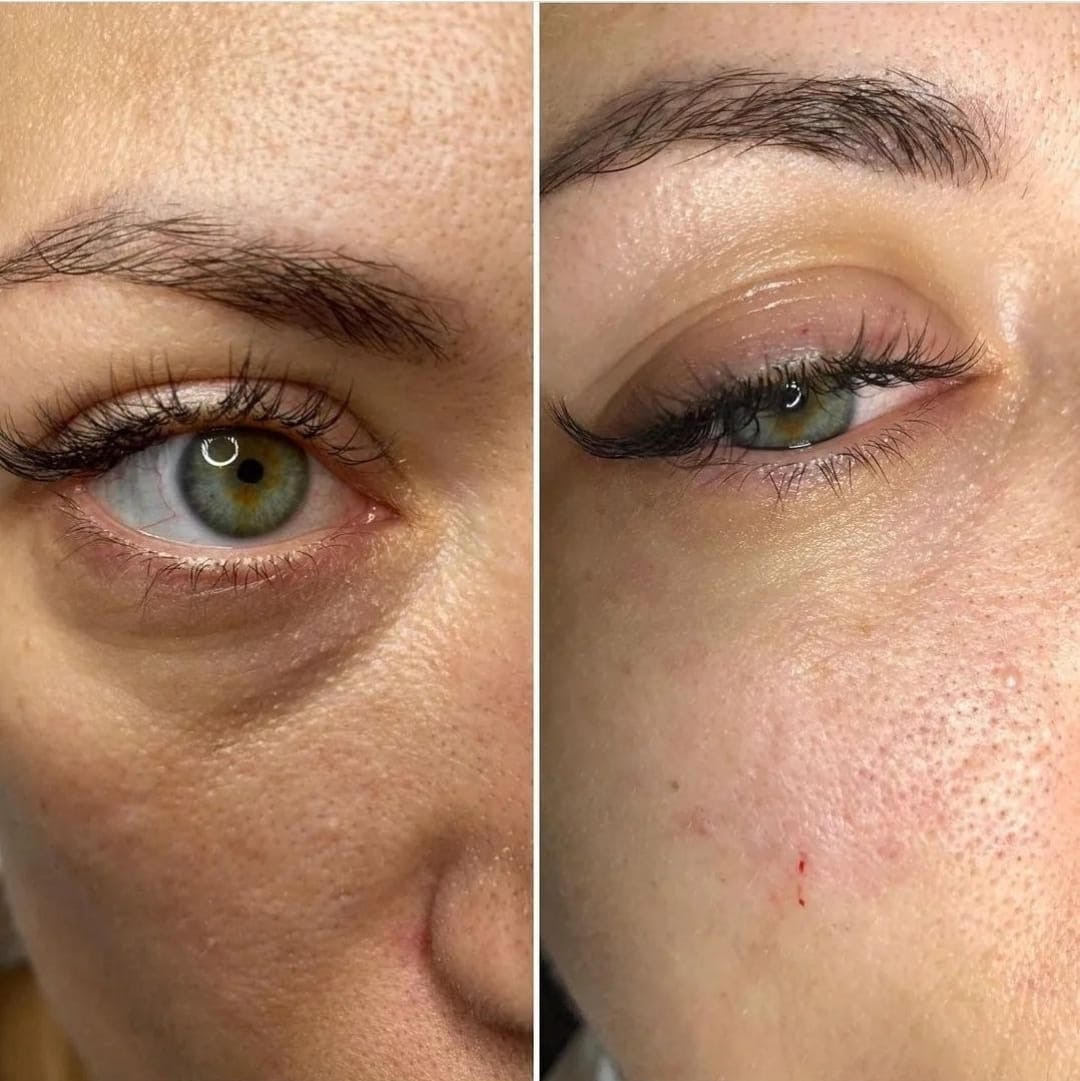 Before and after Under-Eye Filler