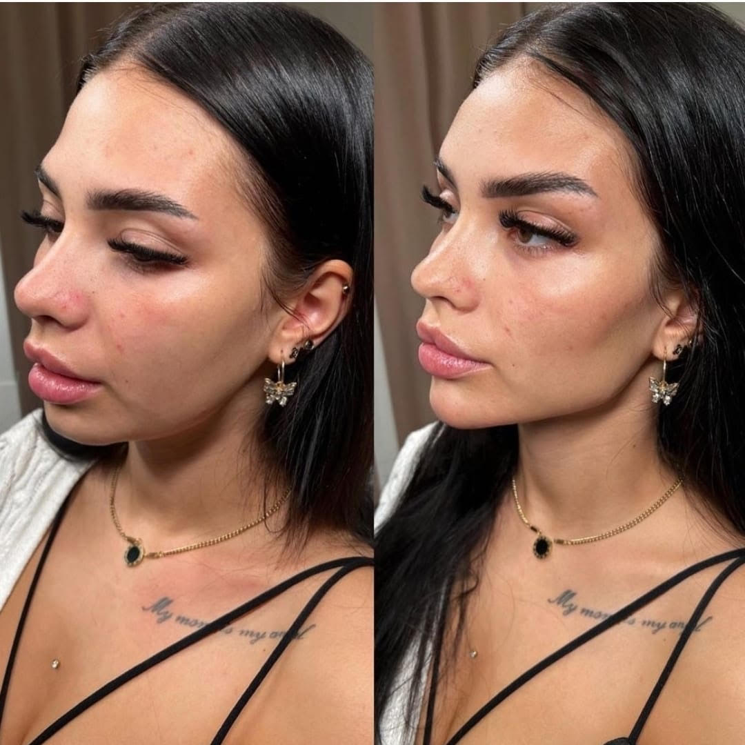 Before and after Non-Surgical Face Lifting
